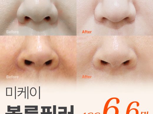 미케이 자연스러운 맞춤 필러_입술, 턱끝, 팔자