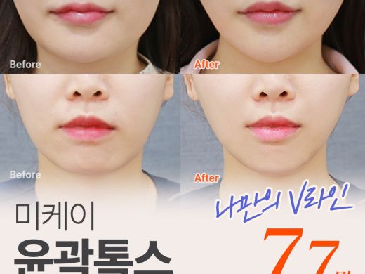 미케이 V라인 윤곽톡스_윤곽주사, 사각턱 보톡스