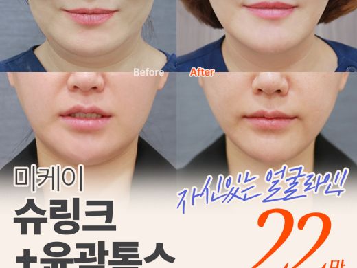 미케이 눈에 띄는 리프팅 효과_슈링크400샷, V윤곽톡스
