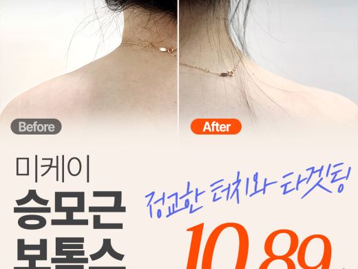 미케이 승모근&종아리보톡스_눈가, 미간, 입꼬리, 스킨보톡스