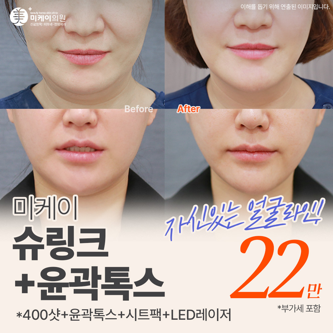 미케이 눈에 띄는 리프팅 효과_슈링크400샷, V윤곽톡스