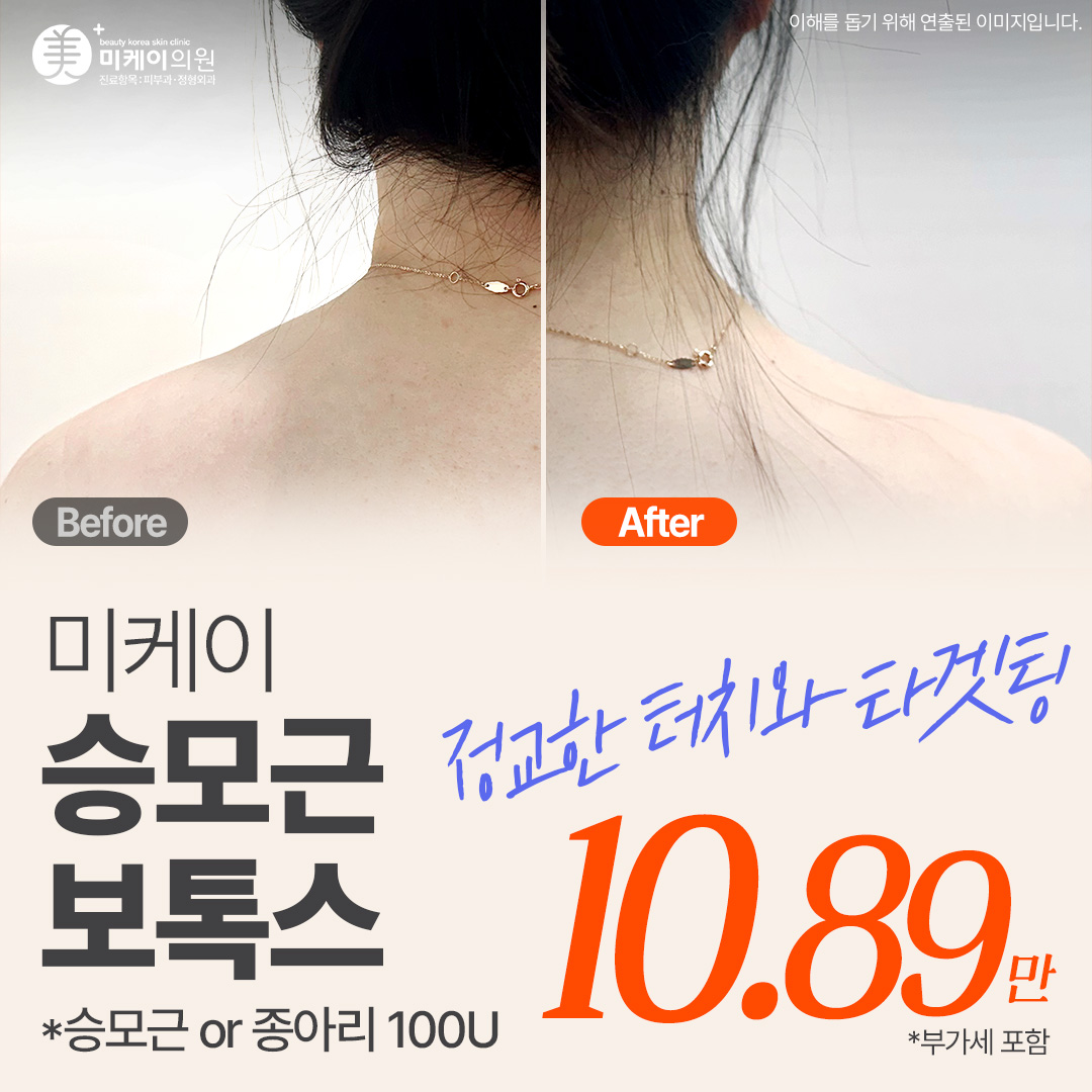 미케이 승모근&종아리보톡스_눈가, 미간, 입꼬리, 스킨보톡스