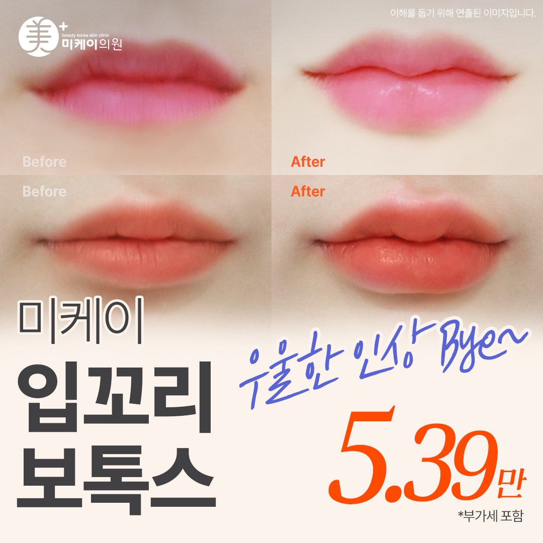 미케이 과즙미 팡팡_입꼬리 보톡스