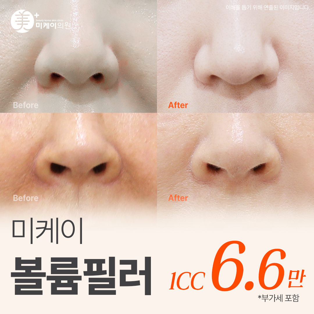 미케이 자연스러운 맞춤 필러_입술, 턱끝, 팔자
