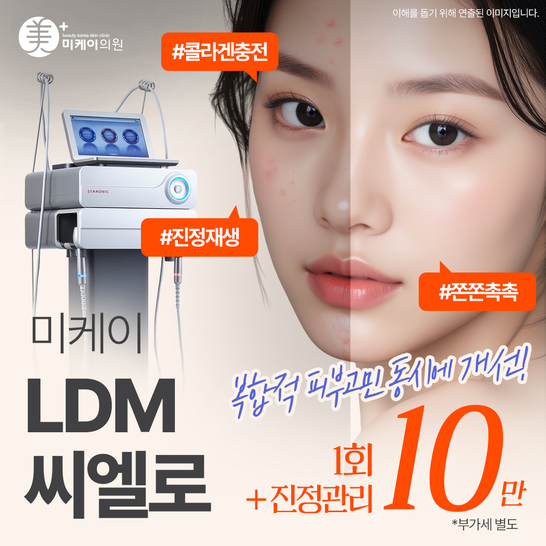 미케이 피부재생, 여드름흉터_LDM