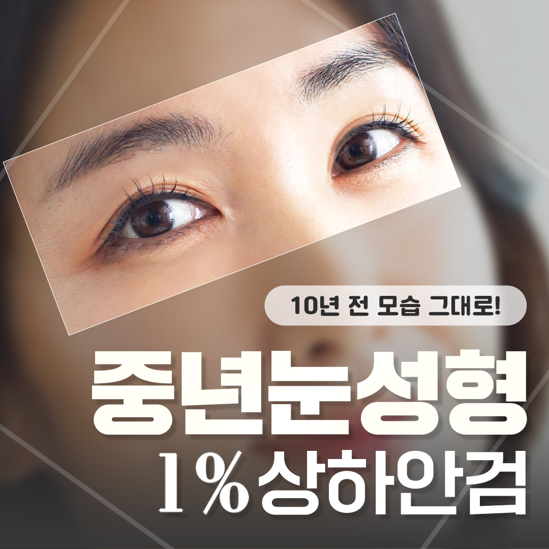 일퍼센트_중년눈성형, 상안검, 하안검