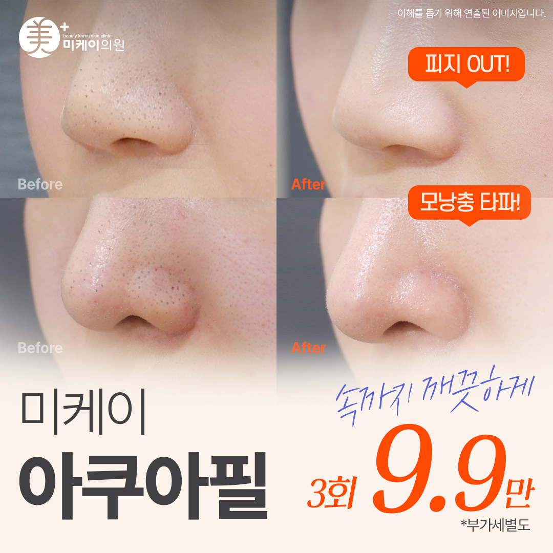 미케이 각질&모공 청소_아쿠아필