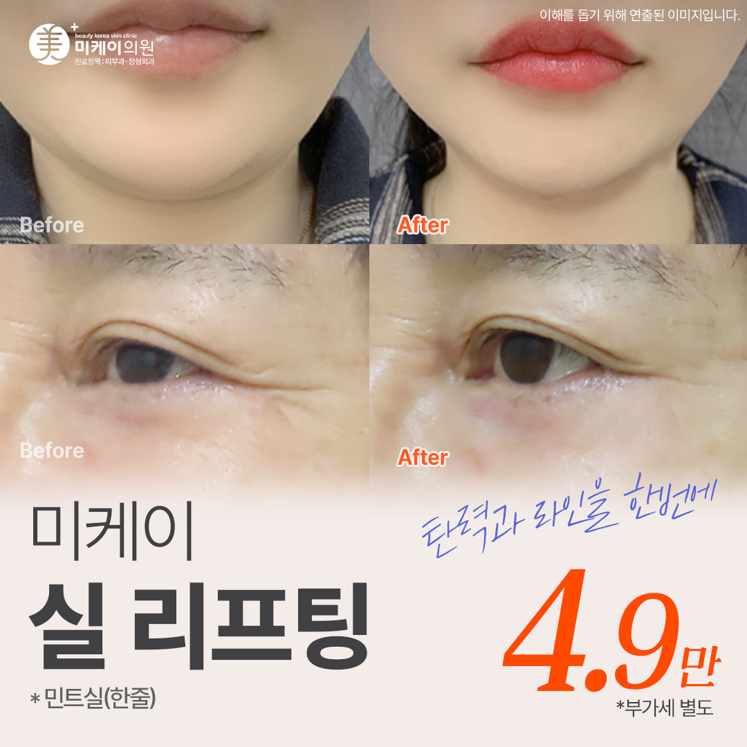 미케이 맞춤형 민트실 동안 리프팅_팔자, 이중턱, 눈가