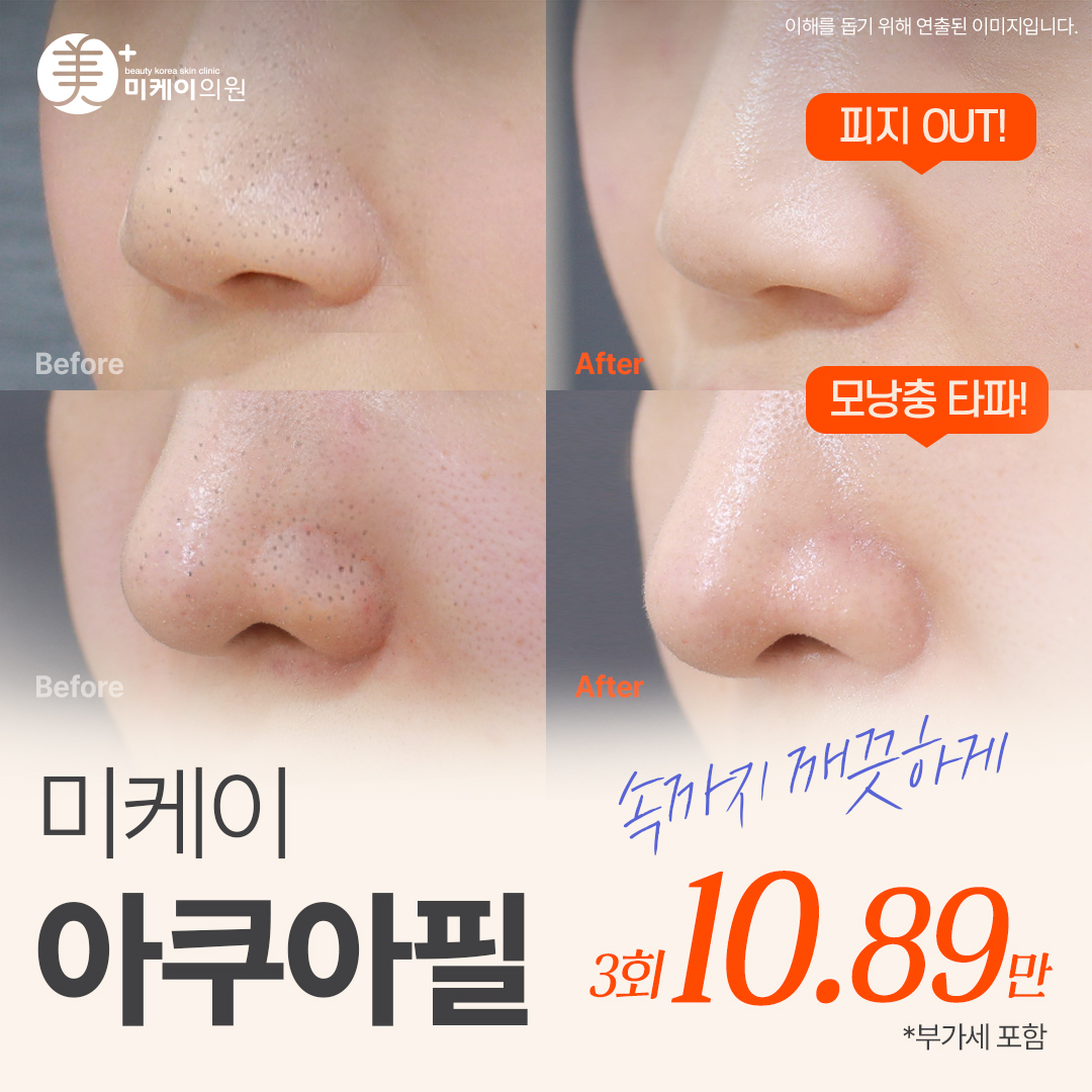 미케이 1대1 맞춤 각질&모공 청소 _아쿠아필
