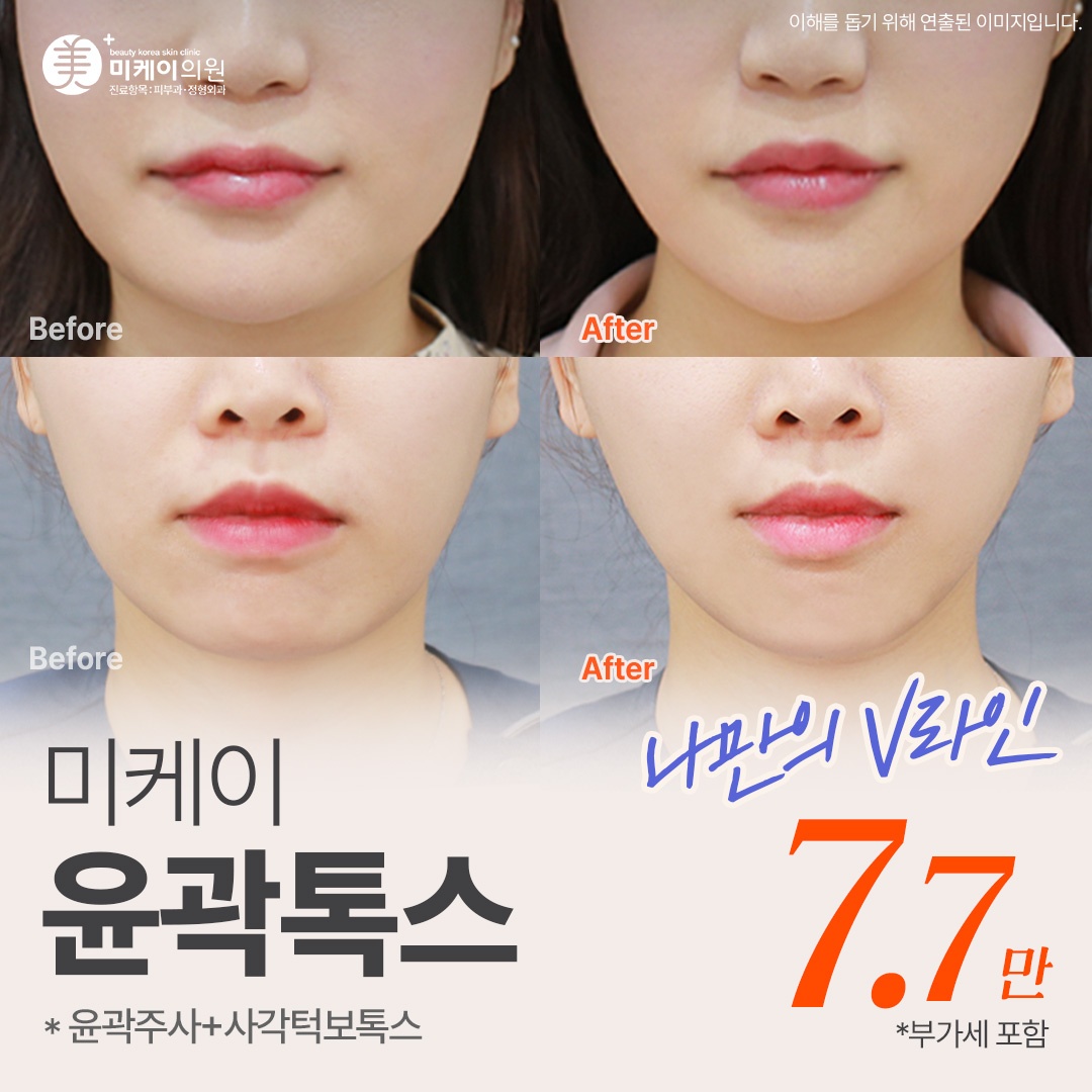 미케이 V라인 윤곽톡스_윤곽주사, 사각턱 보톡스