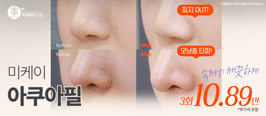 미케이 1대1 맞춤 각질&모공 청소 _아쿠아필 - 미케이의원