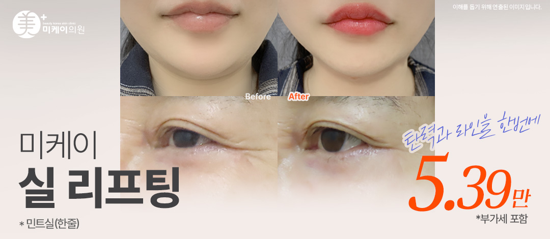 미케이 맞춤형 민트실 동안 리프팅_팔자, 이중턱, 눈가 - 미케이의원