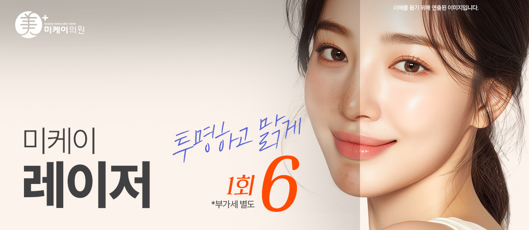 미케이 기미 잡티 색소침착 여드름 자국 지우개_레이저토닝 - 미케이의원