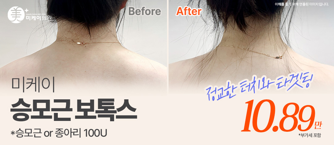 미케이 승모근&종아리보톡스_눈가, 미간, 입꼬리, 스킨보톡스 - 미케이의원