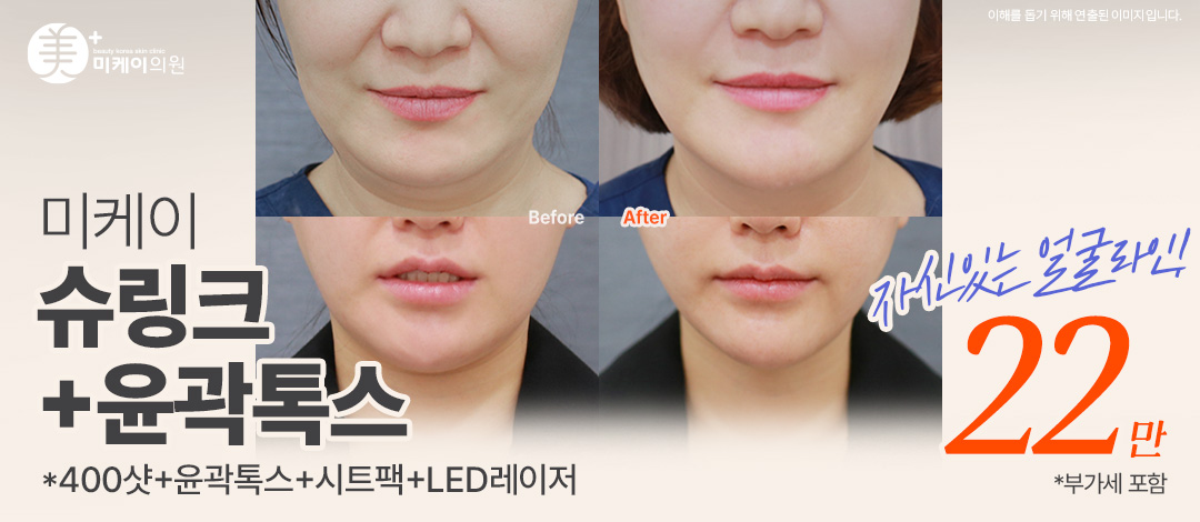 미케이 눈에 띄는 리프팅 효과_슈링크400샷, V윤곽톡스 - 미케이의원